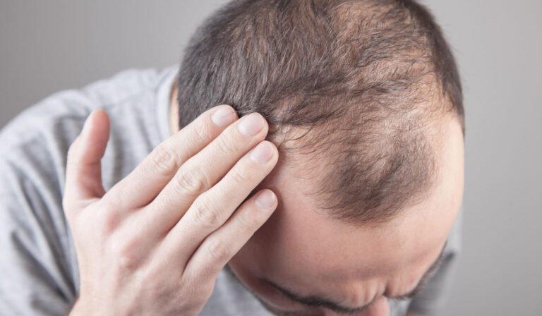 Baldness? UCLA’s New Molecule Could Revolutionize Hair Growth