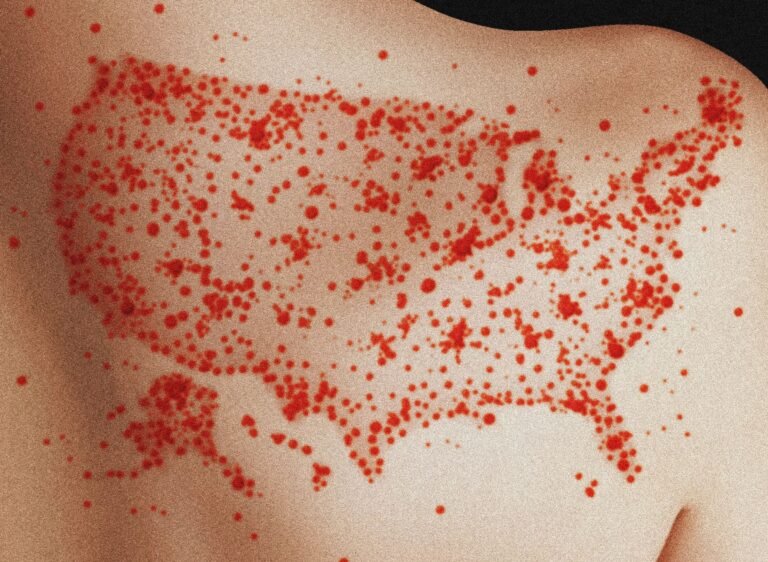 Scientists Find Measles Likely To Become Endemic in the US Over Next 20 Years