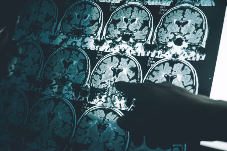How the Alzheimer’s Research Scandal Set Back Treatment 16 Years (2022)