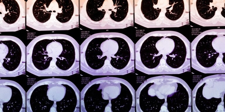 AI could predict who will have a heart attack